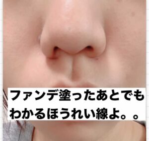 ほうれい線のせいで老けて見えるから 何とかしたい 速攻でケアする方法は アラフォーママのコスメ口コミブログ ほうれい線のせいで老けて見えるから 何とかしたい 速攻でケアする方法は アラフォーママのコスメ口コミブログ